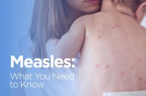 Measles: What you need to know