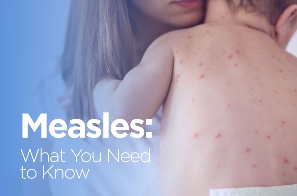 Measles: What you need to know
